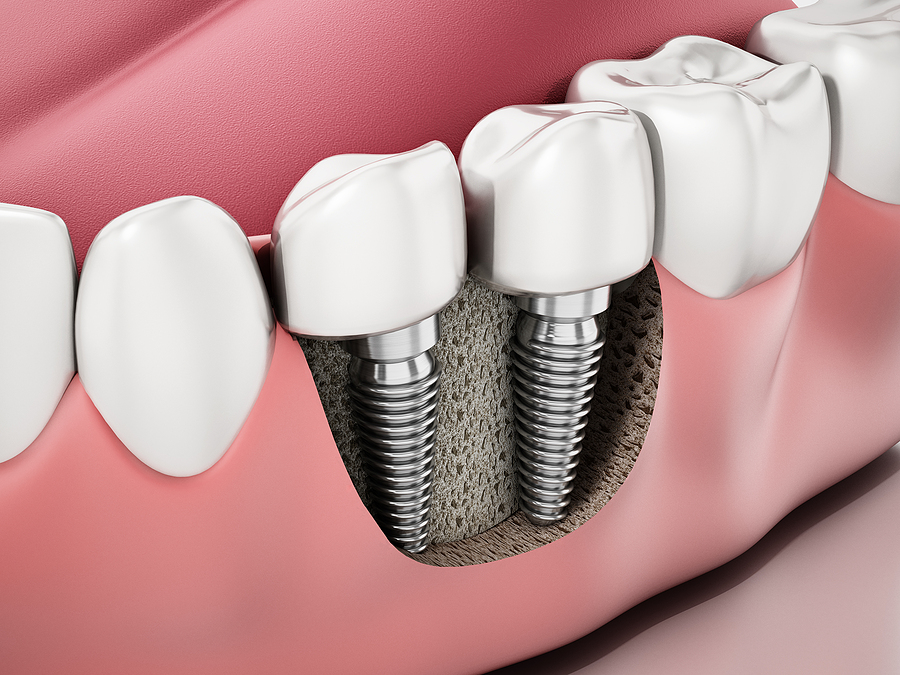 Transform Your Smile with Dental Implants in Campbell, CA